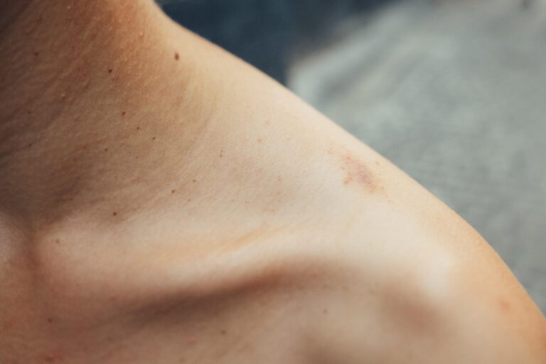 skadeerstatning - blåmerke på skulderen til en person